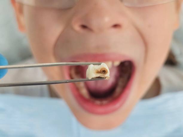 Best Emergency Dentist for Knocked-Out Tooth in Elm City, NC
